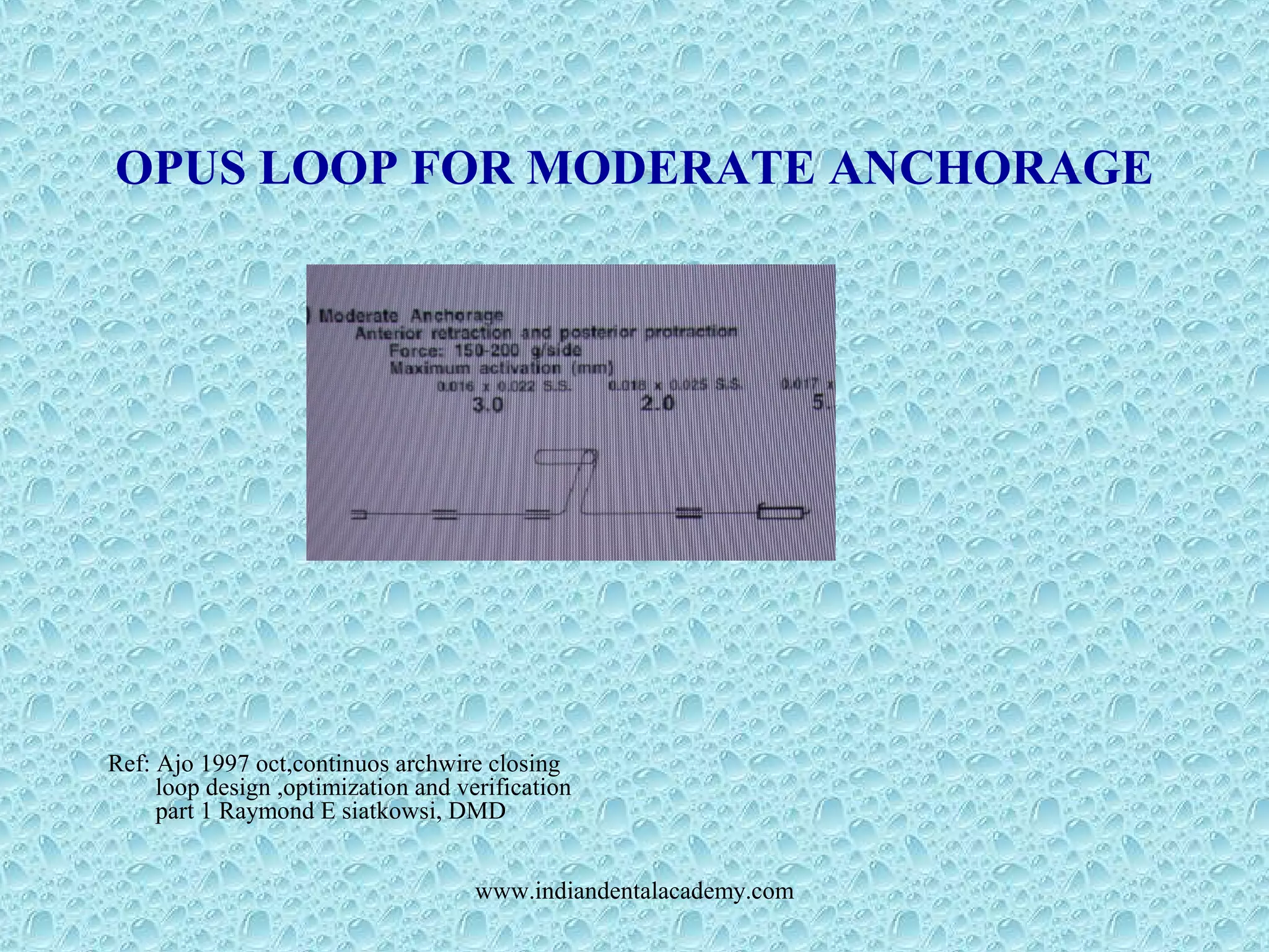 OPUS LOOP FOR MODERATE ANCHORAGE
Ref: Ajo 1997 oct,continuos archwire closing
loop design ,optimization and verification
part 1 Raymond E siatkowsi, DMD
www.indiandentalacademy.com
 