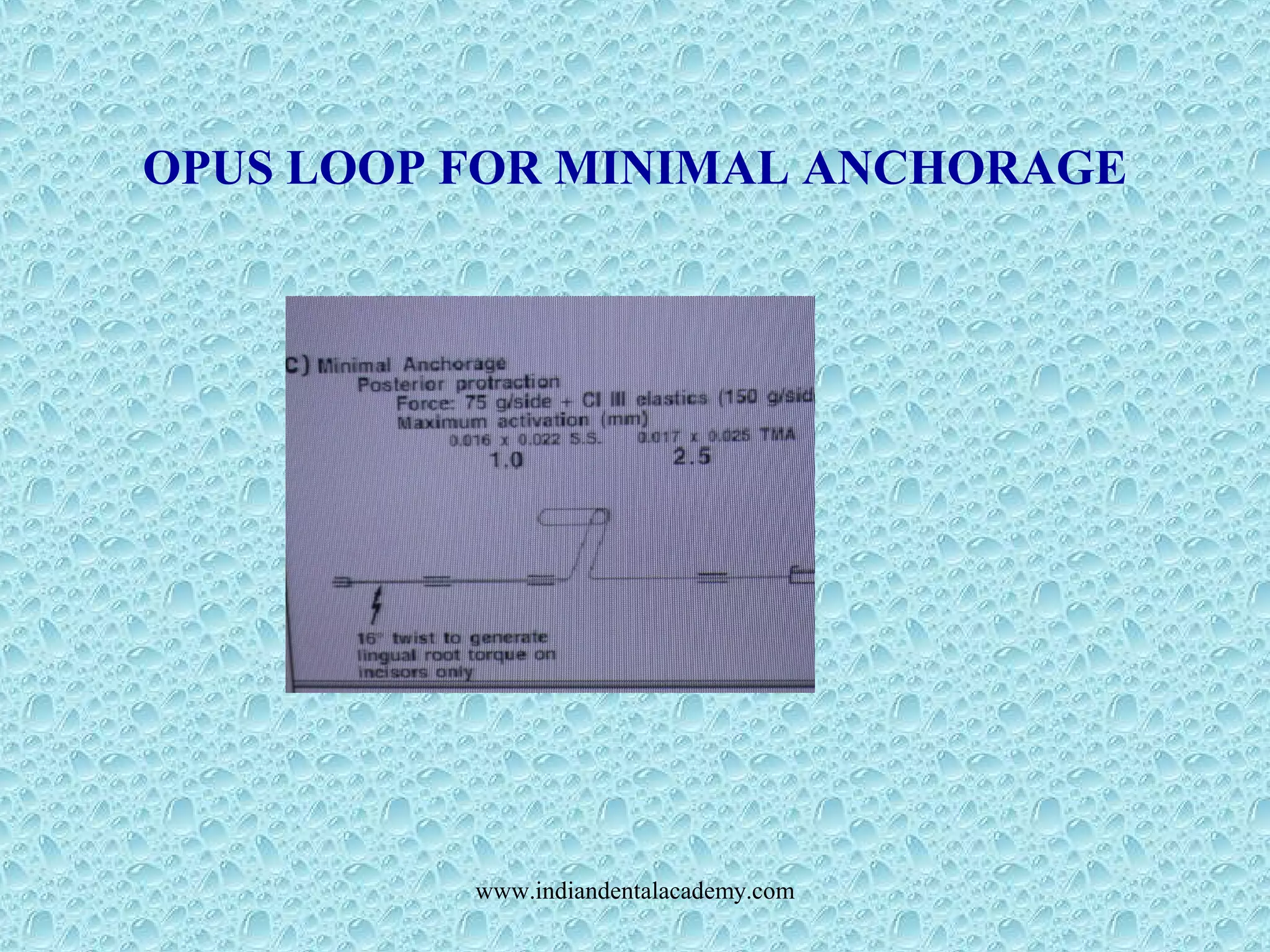 OPUS LOOP FOR MINIMAL ANCHORAGE
www.indiandentalacademy.com
 