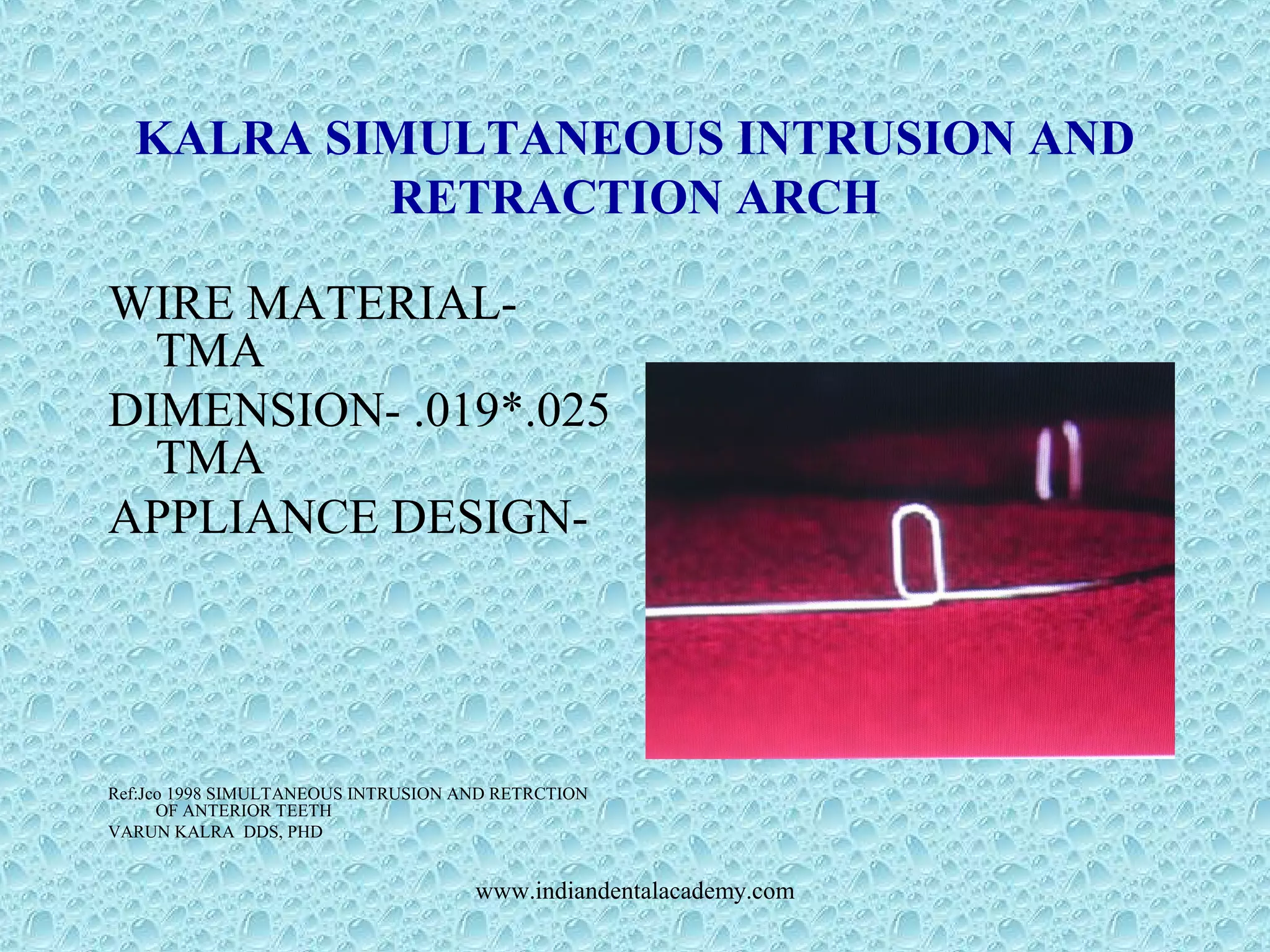KALRA SIMULTANEOUS INTRUSION AND
RETRACTION ARCH
WIRE MATERIAL-
TMA
DIMENSION- .019*.025
TMA
APPLIANCE DESIGN-
Ref:Jco 1998 SIMULTANEOUS INTRUSION AND RETRCTION
OF ANTERIOR TEETH
VARUN KALRA DDS, PHD
www.indiandentalacademy.com
 