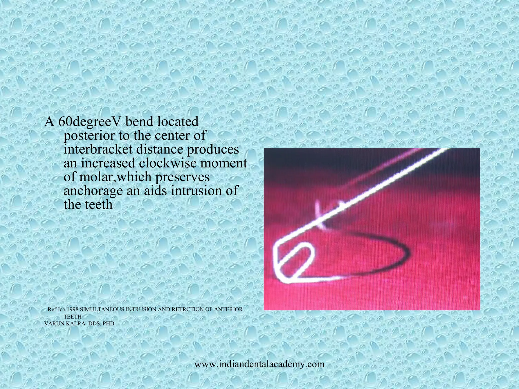 A 60degreeV bend located
posterior to the center of
interbracket distance produces
an increased clockwise moment
of molar,which preserves
anchorage an aids intrusion of
the teeth
Ref:Jco 1998 SIMULTANEOUS INTRUSION AND RETRCTION OF ANTERIOR
TEETH
VARUN KALRA DDS, PHD
www.indiandentalacademy.com
 