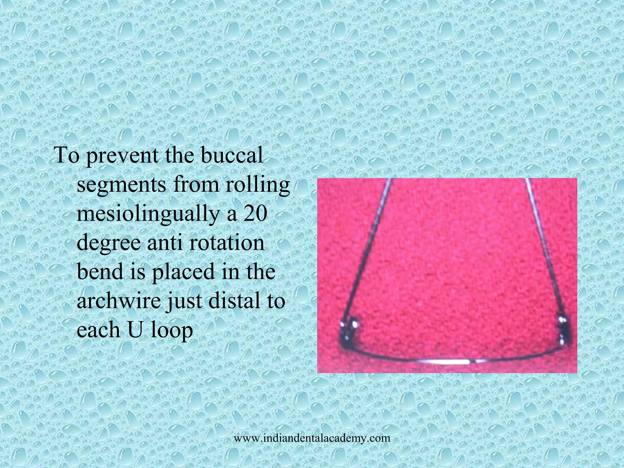 To prevent the buccal
segments from rolling
mesiolingually a 20
degree anti rotation
bend is placed in the
archwire just distal to
each U loop
www.indiandentalacademy.com
 