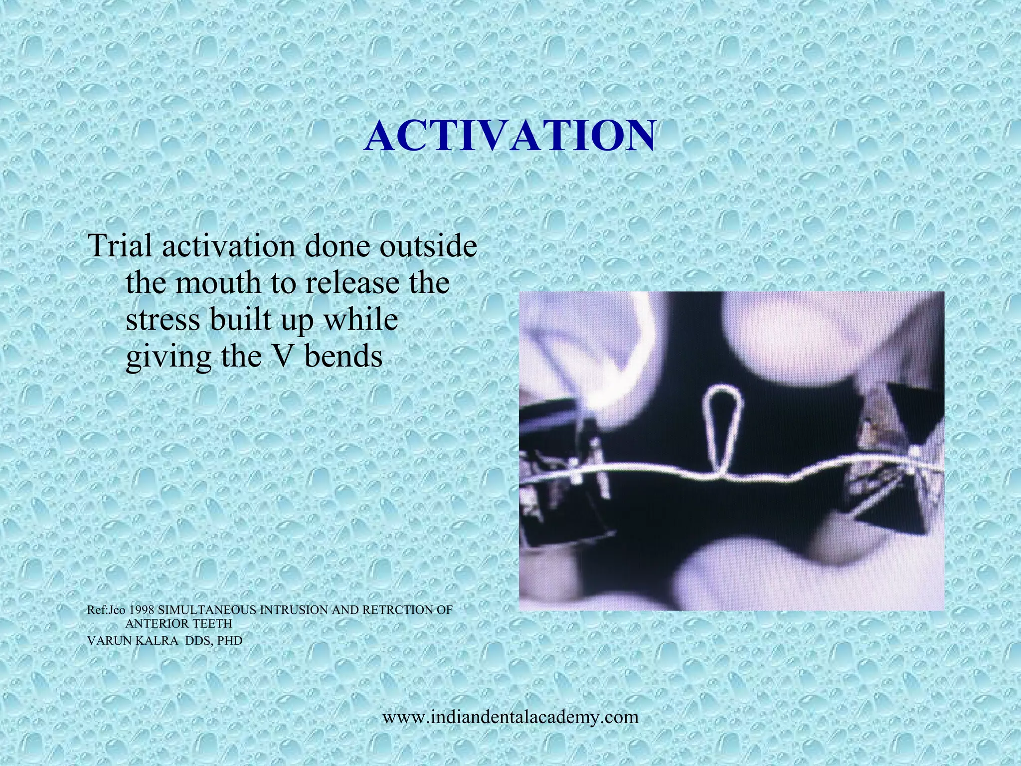 ACTIVATION
Trial activation done outside
the mouth to release the
stress built up while
giving the V bends
Ref:Jco 1998 SIMULTANEOUS INTRUSION AND RETRCTION OF
ANTERIOR TEETH
VARUN KALRA DDS, PHD
www.indiandentalacademy.com
 