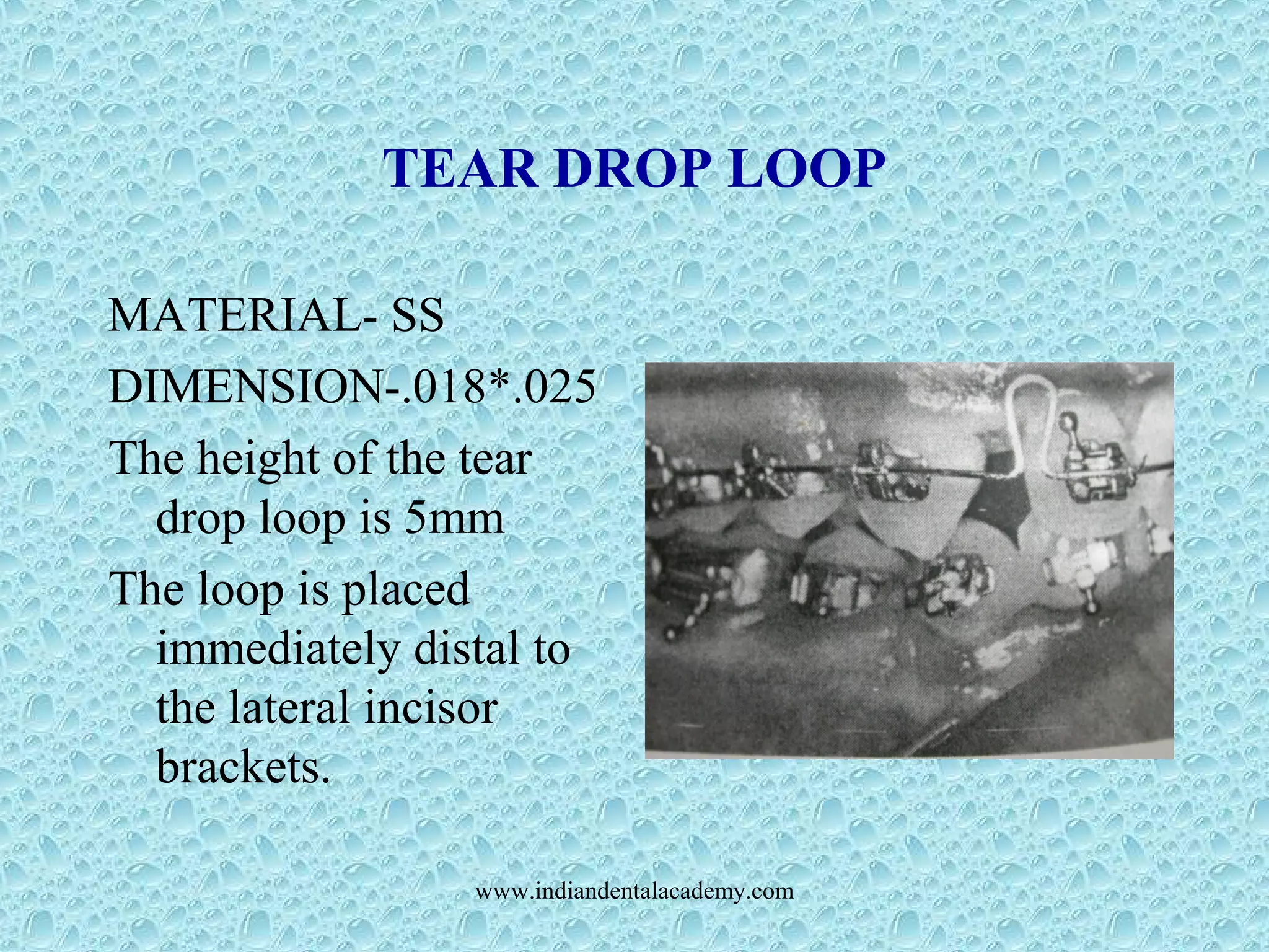 TEAR DROP LOOP
MATERIAL- SS
DIMENSION-.018*.025
The height of the tear
drop loop is 5mm
The loop is placed
immediately distal to
the lateral incisor
brackets.
www.indiandentalacademy.com
 