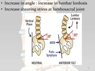 • Increase in angle : increase in lumbar lordosis
• Increase shearing stress at lumbosacral joint
16
 