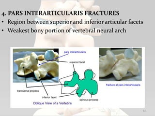 4. PARS INTERARTICULARIS FRACTURES
• Region between superior and inferior articular facets
• Weakest bony portion of vertebral neural arch
62
 