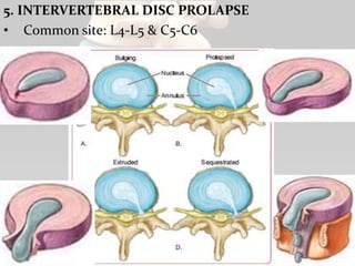 5. INTERVERTEBRAL DISC PROLAPSE
• Common site: L4-L5 & C5-C6
65
 