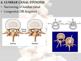 6. LUMBAR CANAL STENOSIS
• Narrowing of lumbar canal
• Congenital OR Acquired
66
 