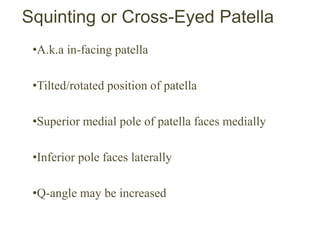 Squinting or Cross-Eyed Patella
•A.k.a in-facing patella
•Tilted/rotated position of patella
•Superior medial pole of patella faces medially
•Inferior pole faces laterally
•Q-angle may be increased
 