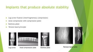 Biomechanics of Rigid Fixation and Achieving Absolute Stability in ...