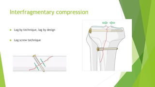 Biomechanics of Rigid Fixation and Achieving Absolute Stability in ...