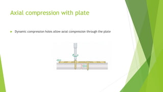Axial Compression In Real Life Biomechanics of Rigid Fixation and Achieving Absolute Stability in ...