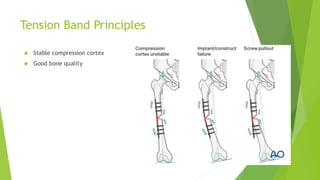 Biomechanics of Rigid Fixation and Achieving Absolute Stability in ...