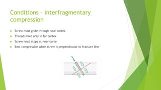 Biomechanics of Rigid Fixation and Achieving Absolute Stability in ...