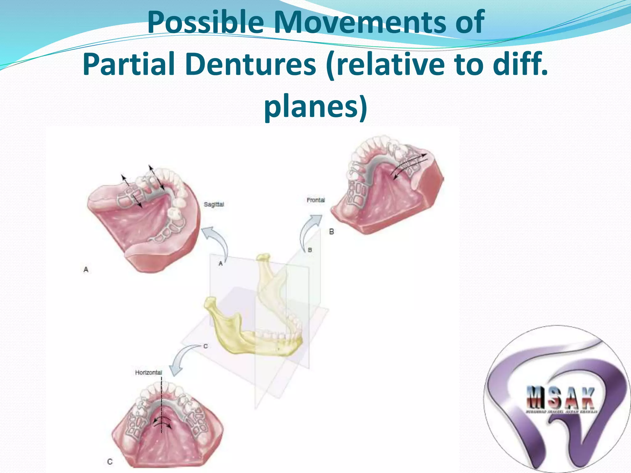 Frs Rpd Biomechanics of rpd | PPTX