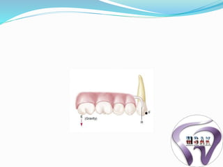 Tooth Lrpd Biomechanics of rpd | PPTX