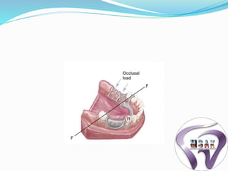 Frs Rpd Biomechanics of rpd | PPTX