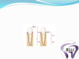 Biomechanics of rpd | PPTX