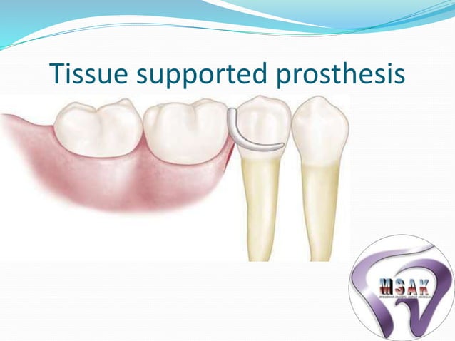 Biomechanics of rpd | PPTX | Dental Health | Diseases and Conditions