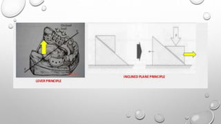 Lever System Rpd Biomechanics of RPD | PPTX