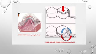 Biomechanics of RPD | PPTX