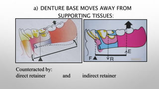 Support Stability Retention Rpd Biomechanics of RPD | PPTX