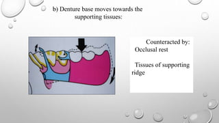 Biomechanics of RPD | PPTX