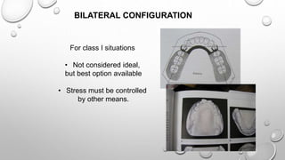 Biomechanics of RPD | PPTX