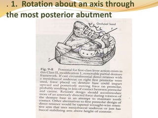 Rotational Rpd Biomechanics of RPD | PPTX