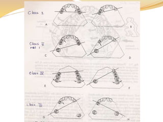 Biomechanics of RPD | PPTX
