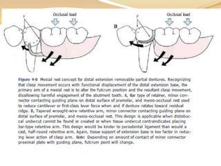 Biomechanics of RPD | PPTX