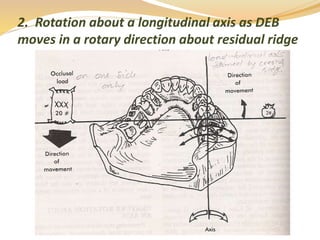 Tissue Ward Rotation Rpd Biomechanics of RPD | PPTX