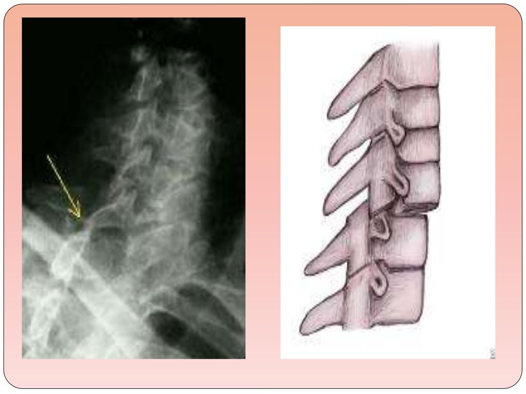 Biomechanics Of The Cervical Spine Ppt 3 