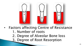 20
• Factors affecting Centre of Resistance
1. Number of roots
2. Degree of Alveolar Bone loss
3. Degree of Root Resorption
 