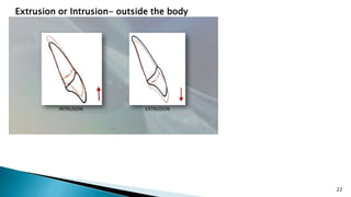 22
Extrusion or Intrusion- outside the body
 