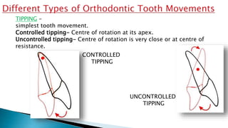 CONTROLLED
TIPPING
TIPPING –
simplest tooth movement.
Controlled tipping- Centre of rotation at its apex.
Uncontrolled tipping- Centre of rotation is very close or at centre of
resistance.
UNCONTROLLED
TIPPING
 