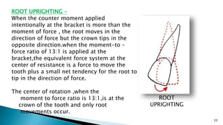 33
ROOT
UPRIGHTING
ROOT UPRIGHTING –
When the counter moment applied
intentionally at the bracket is more than the
moment of force , the root moves in the
direction of force but the crown tips in the
opposite direction.when the moment-to –
force ratio of 13:1 is applied at the
bracket,the equivalent force system at the
center of resistance is a force to move the
tooth plus a small net tendency for the root to
tip in the direction of force.
The center of rotation ,when the
moment to force ratio is 13:1,is at the
crown of the tooth and only root
movements occur.
 