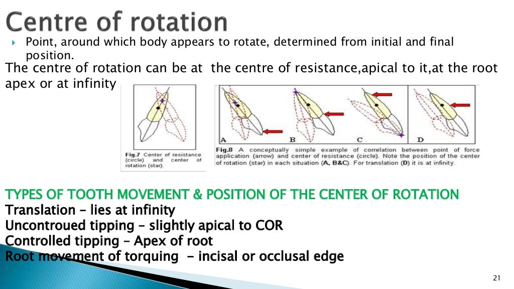 Orthodontic tooth movements and biomechanics.