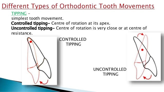 「orthodontic tipping tooth movement」的圖片搜尋結果