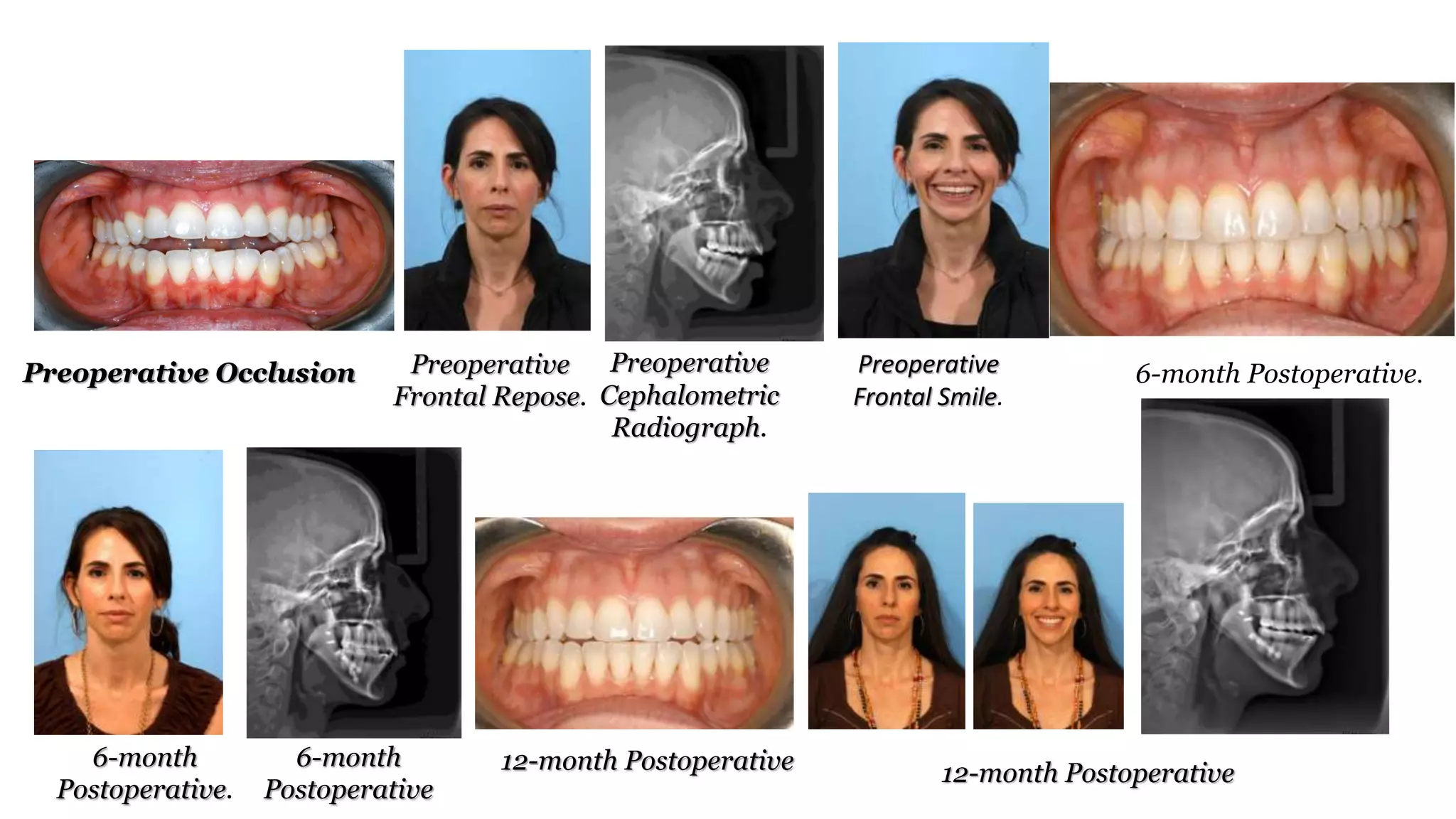 orthodontic biomechanics of skeleta deformities part 3 | PPTX
