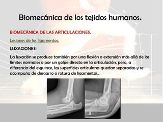 Biomecánica de los tejidos humanos.
BIOMECÁNICA DE LAS ARTICULACIONES.
Lesiones de los ligamentos.
LUXACIONES:
La luxación se produce también por una flexión o extensión más allá de los
límites normales o por un golpe directo en la articulación, pero, a
diferencia del esguince, las superficies articulares quedan separadas y se
acompaña de desgarro o rotura de ligamentos..
 