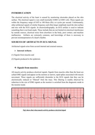 INTRODUCATION
The electrical activity of the heart is sensed by monitoring electrodes placed on the skin
surface. The electrical signal is very small (normally 0.0001 to 0.003 volt). These signals are
within the frequency range of 0.05 to 100 Hertz (Hz.) or cycles per second. Unfortunately,
other artifactual signals of similar frequency and often larger amplitude reach the skin surface
and mix with the ECG signals. In electrocardiography, an ECG artifact is used to indicate
something that is not heart-made. These include (but are not limited to) electrical interference
by outside sources, electrical noise from elsewhere in the body, poor contact, and machine
malfunction. Artifacts are extremely common, and knowledge of them is necessary to
prevent misinterpretation of a heart's rhythm.

SOURCES OF ARTIFACTS IN ECG SIGNAL
Artifactual signals arise from several internal and external sources.

    Internal Arifacts:

(1) Signals from muscles and

(2) Signals produced in the epidermis



    Signals from muscles:
All muscle activity produces electrical signals. Signals from muscles other than the heart are
called EMG signals and appear on the monitor as narrow, rapid spikes associated with muscle
movement. These signals are sufficiently dissimilar to the ECG signals that they can be
electronically reduced or "filtered" from the trace. This filtering is readily observed by
reduction in the size of EMG signals as the monitor is switched from the diagnostic mode to
the monitor mode.




               Fig1 shows that when muscle activity produces electrical signal
 