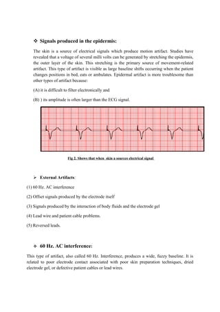  Signals produced in the epidermis:
   The skin is a source of electrical signals which produce motion artifact. Studies have
   revealed that a voltage of several milli volts can be generated by stretching the epidermis,
   the outer layer of the skin. This stretching is the primary source of movement-related
   artifact. This type of artifact is visible as large baseline shifts occurring when the patient
   changes positions in bed, eats or ambulates. Epidermal artifact is more troublesome than
   other types of artifact because:

   (A) it is difficult to filter electronically and

   (B) ) its amplitude is often larger than the ECG signal.




                        Fig 2. Shows that when skin a sources electrical signal




    External Artifacts:

(1) 60 Hz. AC interference

(2) Offset signals produced by the electrode itself

(3) Signals produced by the interaction of body fluids and the electrode gel

(4) Lead wire and patient cable problems.

(5) Reversed leads.



      60 Hz. AC interference:
This type of artifact, also called 60 Hz. Interference, produces a wide, fuzzy baseline. It is
related to poor electrode contact associated with poor skin preparation techniques, dried
electrode gel, or defective patient cables or lead wires.
 