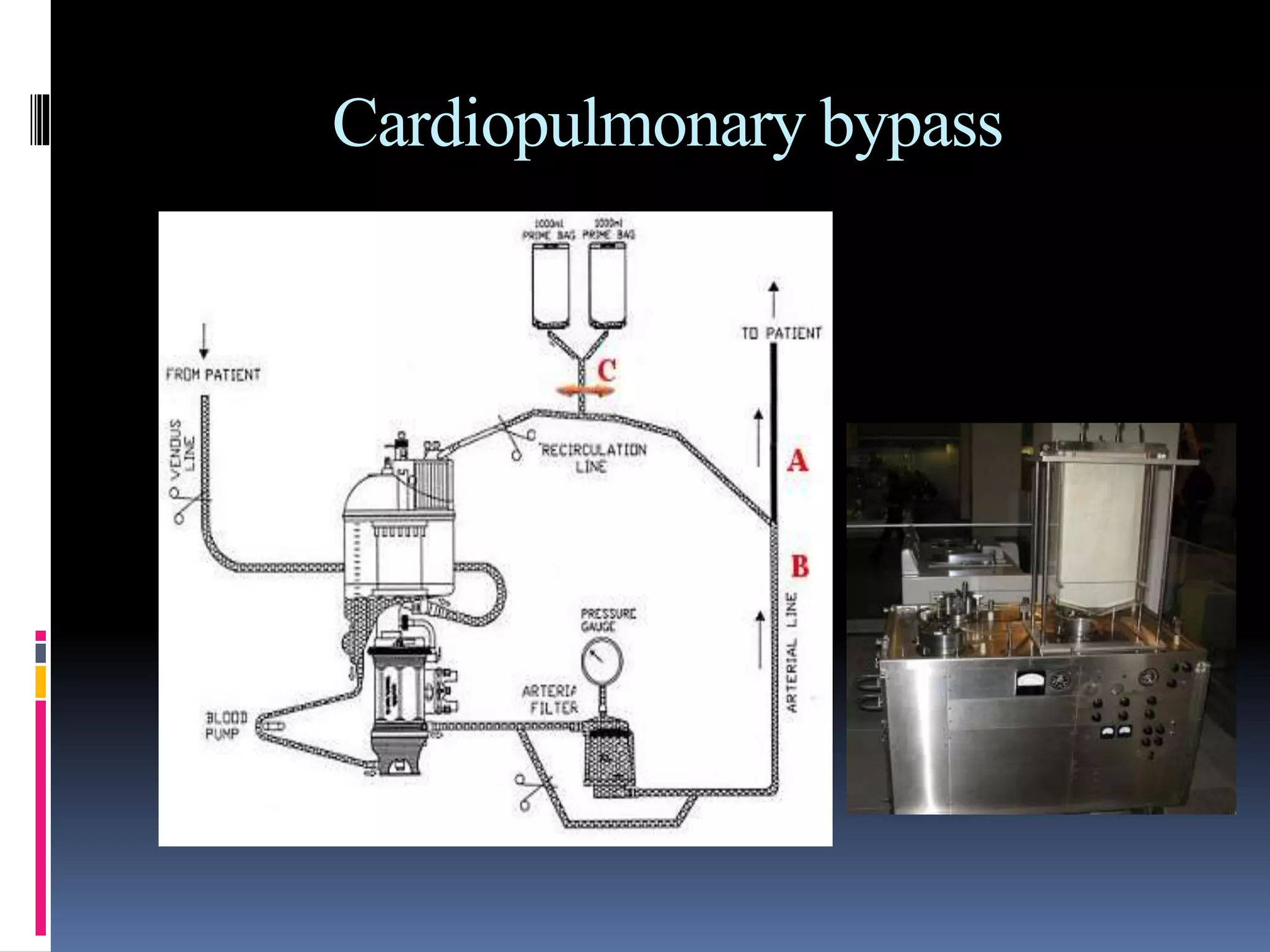Cardiopulmonary bypass
 