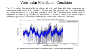 Ventricular Fibrillation Condition
The VF is mainly characterized by the absence of peaks and drops with large magnitudes, the
samples magnitude ranges from .3 volts to -.15 volts only. The algorithm tests if any given sample
lies outside the interval [-0.5, 0.5]. The samples of the VF ECG waveform have narrow range of
magnitudes as shown in Fig., therefore the threshold of ± .5 volts was chosen. If the number of peaks
counted is equal to 0, it is concluded that the patient suffers from Ventricular Fibrillation.
Fig. VF Ventricular Fibrillation ECG waveform with a narrow range of amplitudes
 