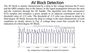 AV Block Detection
The AV block is mainly characterized by a drop in the voltage between the P wave
and the QRS complex due to the latency in the signal propagation between the atria
and the ventricles through the AV bundle. The algorithm tests three consecutive
ECG samples and compares a given sample to its adjacent counterparts and to a
threshold value of -2.5 volts. The threshold of -2.5 volts was chosen to detect the
third degree AV block, because the drop in voltage is the main characteristic of such
conditions as clearly shown in Fig. A voltage–drop count that exceeds 60 is an
indication of a third degree AV Block.
Fig. voltage drop in third degree AV block ECG waveform
 