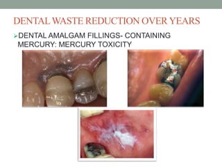 DENTALWASTE REDUCTION OVERYEARS
DENTAL AMALGAM FILLINGS- CONTAINING
MERCURY: MERCURY TOXICITY
 