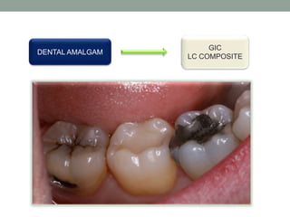 DENTAL AMALGAM
GIC
LC COMPOSITE
 