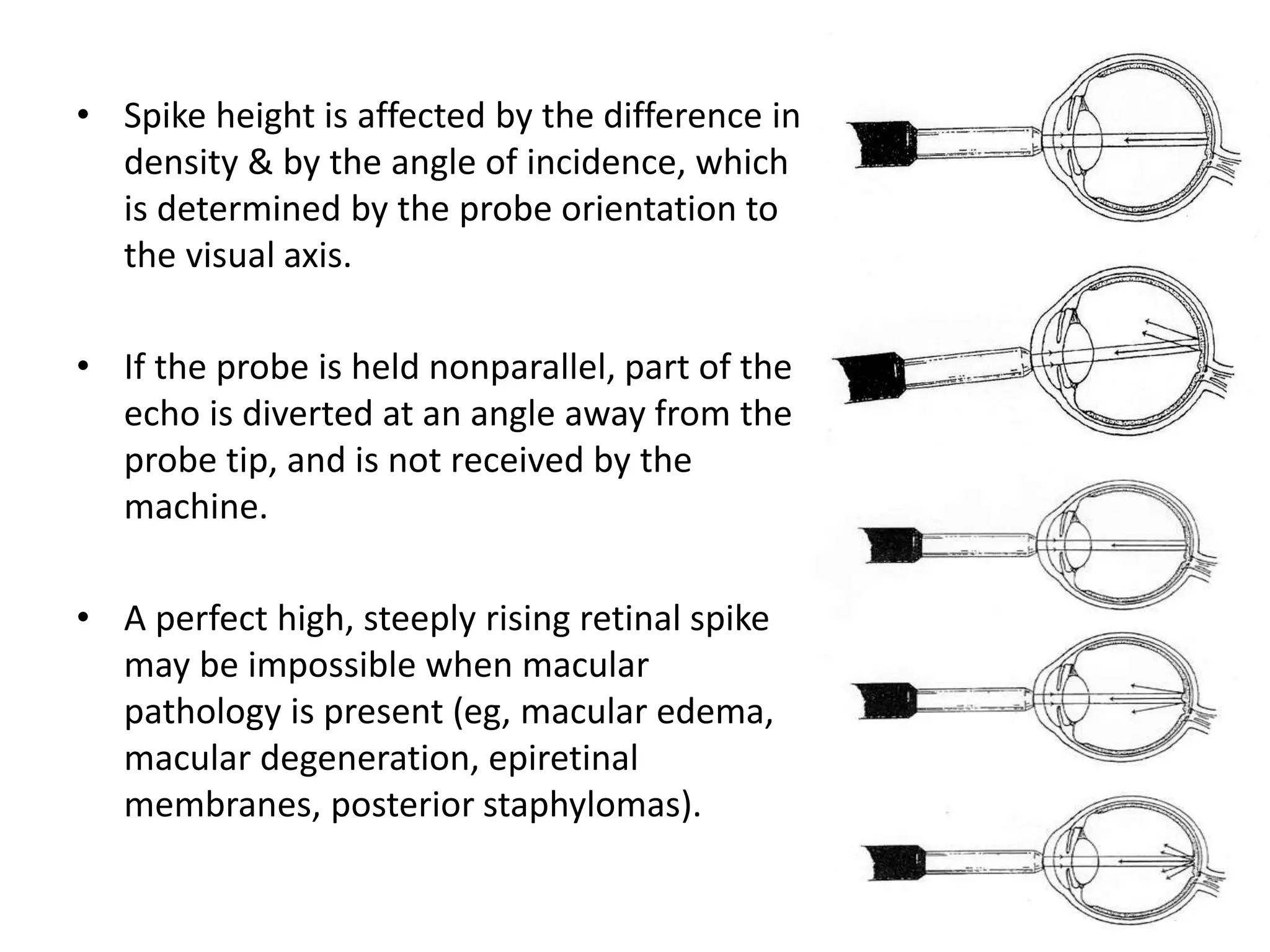 • Spike height is affected by the difference in
density & by the angle of incidence, which
is determined by the probe orientation to
the visual axis.
• If the probe is held nonparallel, part of the
echo is diverted at an angle away from the
probe tip, and is not received by the
machine.
• A perfect high, steeply rising retinal spike
may be impossible when macular
pathology is present (eg, macular edema,
macular degeneration, epiretinal
membranes, posterior staphylomas).
 