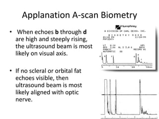 Applanation A-scan Biometry
• When echoes b through d
are high and steeply rising,
the ultrasound beam is most
likely on visual axis.
• If no scleral or orbital fat
echoes visible, then
ultrasound beam is most
likely aligned with optic
nerve.
 
