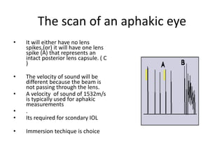 The scan of an aphakic eye
• It will either have no lens
spikes,(or) it will have one lens
spike (A) that represents an
intact posterior lens capsule. ( C
)
• The velocity of sound will be
different because the beam is
not passing through the lens.
• A velocity of sound of 1532m/s
is typically used for aphakic
measurements
• .
• Its required for scondary IOL
• Immersion techique is choice
 
